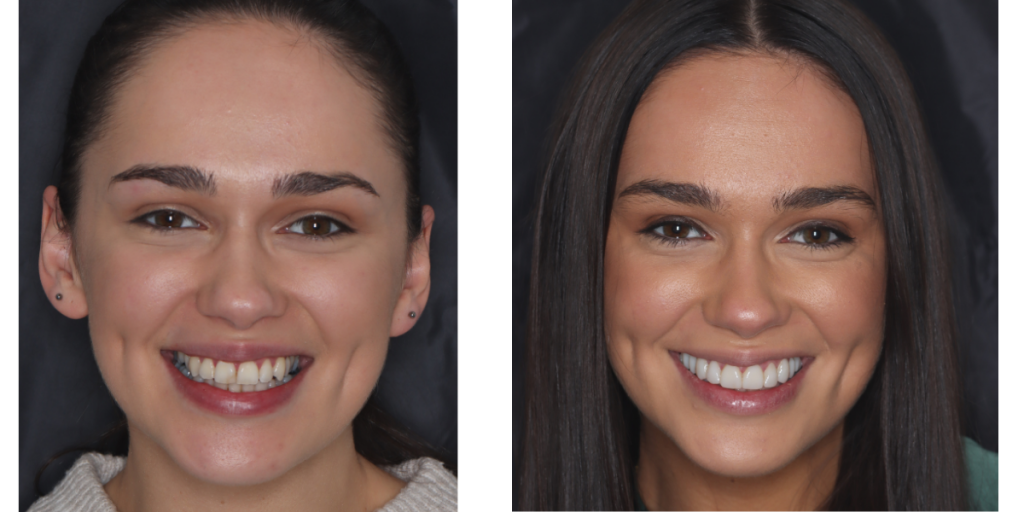 Before and after of Signature Smile case. Left hand picture shows smiling brunette woman with slight discolouration to front teeth, and irregular positioning of incisors and canines. Right hand photo shows same woman with Signature Smiles complete - beautifully straight and naturally white teeth.